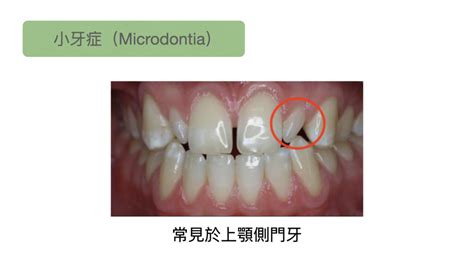 牙齒小顆的人|一顆牙齒特別小，怎麼辦？說明什麼是小牙症，矯正治。